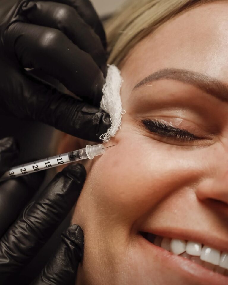 PDO threading lift treatment at Balanced Body in Kaysville, Utah