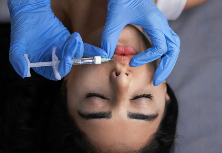 Dermal filler lip and cheek treatment at Balanced Body in Kaysville, Utah