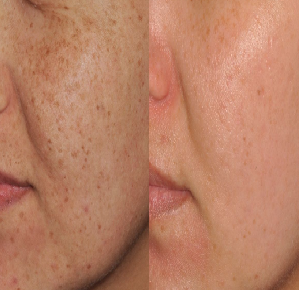 IPL photofacial with Lumecca at Balanced Body in Kaysville, Utah